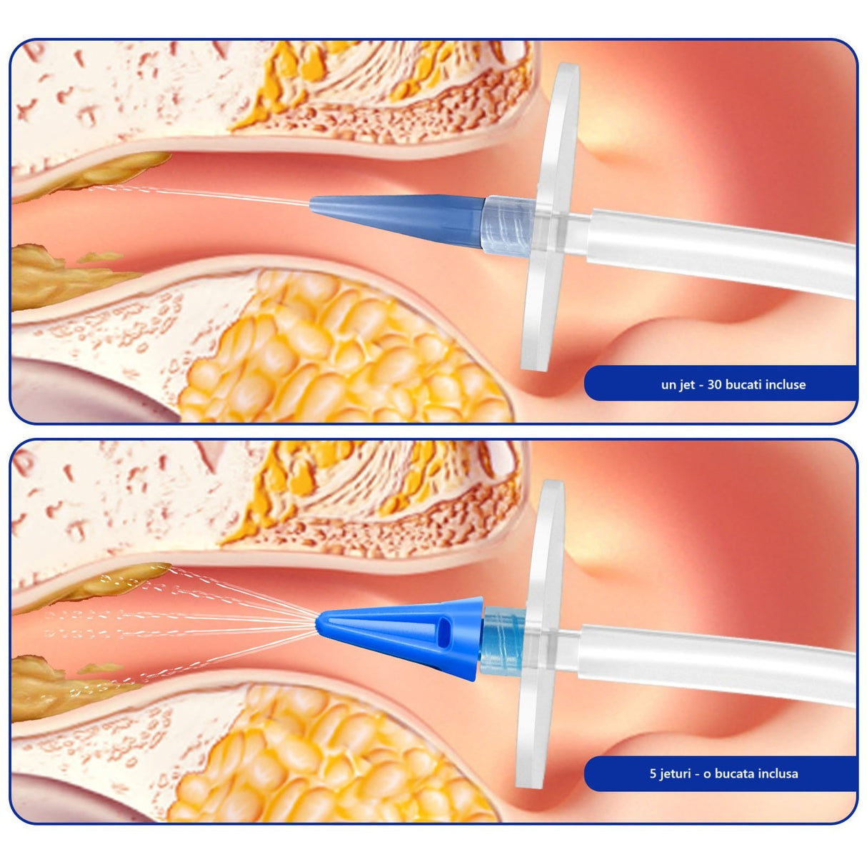 Dispozitiv de Curatare Urechi, Flippy, pentru Indepartare Ceara, Accesorii Incluse, din ABS+PC, Verde